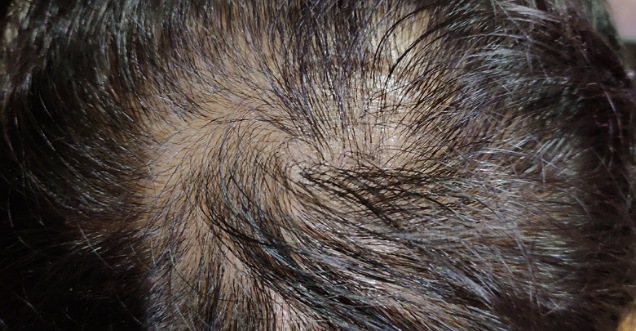 क्या बाल झड़ने का कारण तकिया भी हो सकता हैं ?
