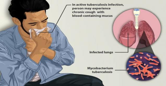 शरीर में दिख रहे इन लक्षणों को ना करें नजरअंदाज बढ़ सकता है टीबी का खतरा